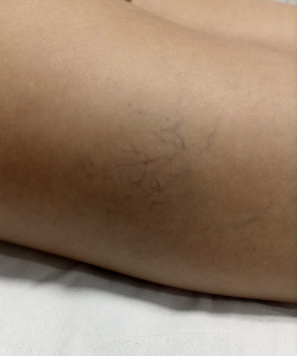 Celulitis antes tratamiento con diatermia